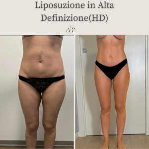 Liposuzione in Alta Definizione