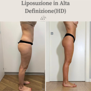 liposcultura vaserlipo liposuzione