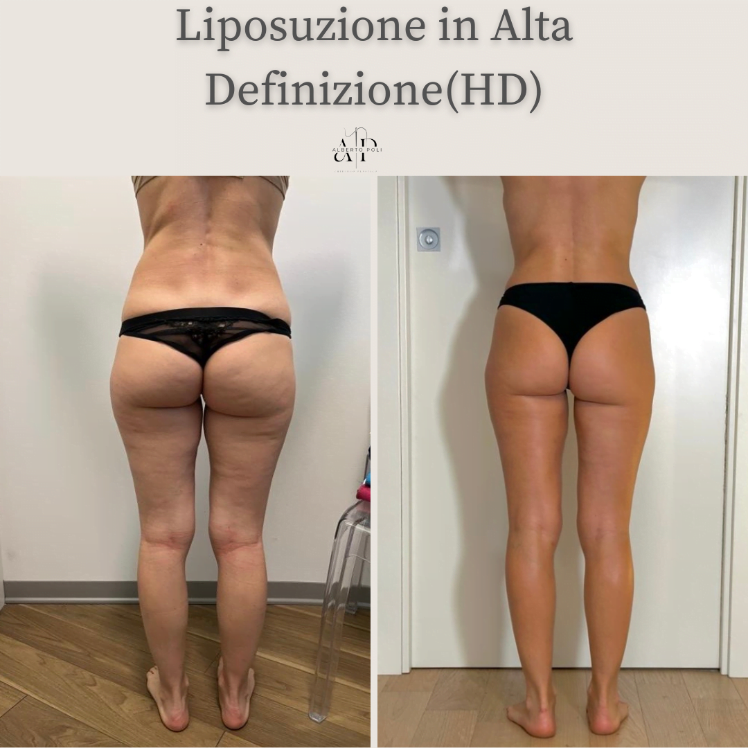 liposcultura vaserlipo liposuzione
