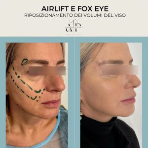 Airlift viso FoxEye Lipo Doppio mento
