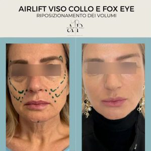 ringiovanimento viso