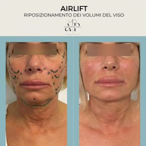 Airlift, lifting non chirurgico, Chirurgia Estetica non invasiva