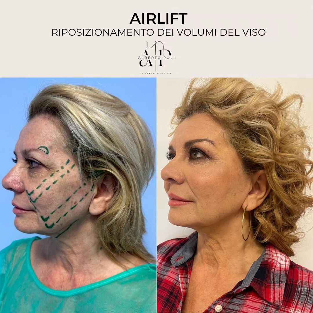 AIR LIFT Alberto Poli Milano