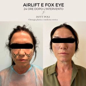 Chirurgia estetica prima dell'Estate; Airlift Viso