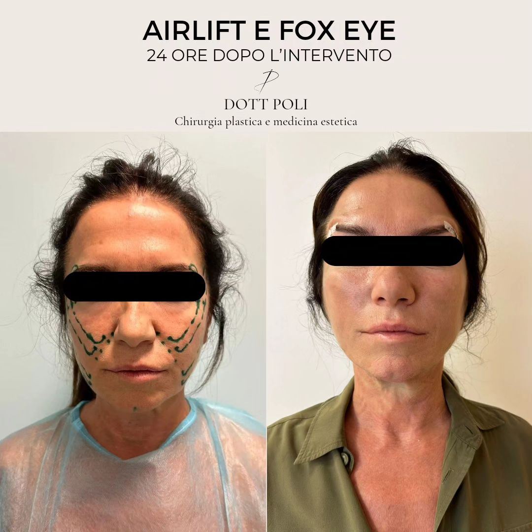 airlift viso Alberto Poli