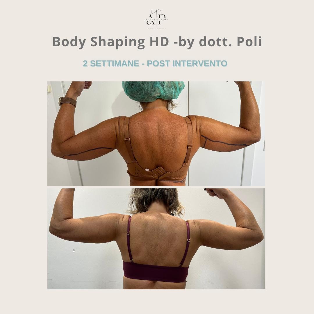 Liposuzione Laser HD+ 1