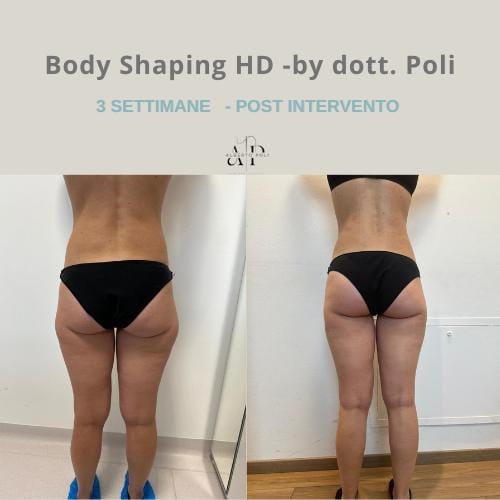 Liposuzione Laser HD+ 3