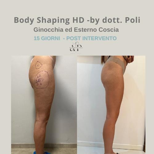 Body Shaping HD