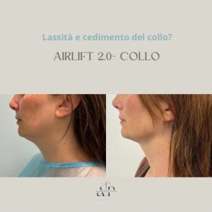 LIFTING DEL COLLO- AIRLIFT 2.0 procedure di chirurgia plastica