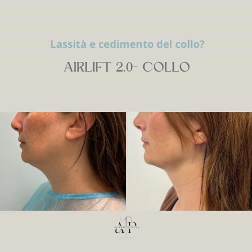 lifting non invasivo Alberto Poli