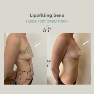 Lipofilling Seno