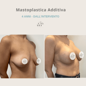 MASTOPLASTICA ADDITIVA 