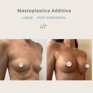 mastoplastica additiva 