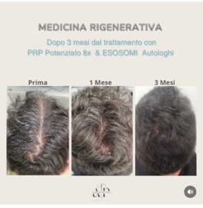 PRP potenziato ×8 con esosomi autologhi